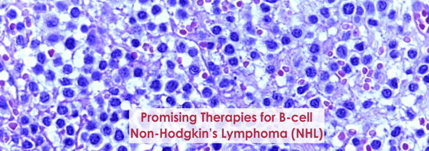 Promising Therapies for B-cell Non-Hodgkin’s Lymphoma (NHL)